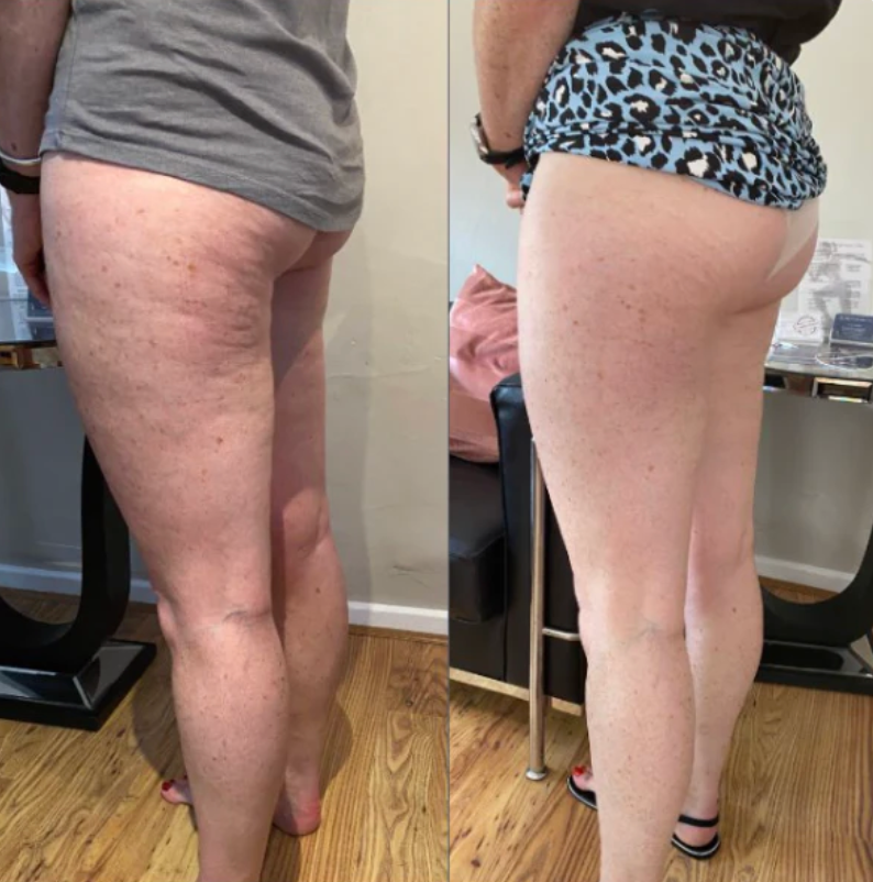 Lumera Cellulite Massager™
