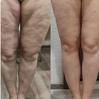 Lumera Cellulite Massager™